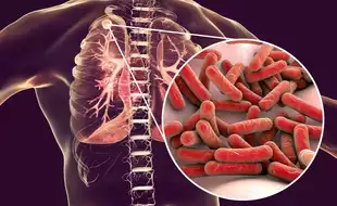 Tuberculosis: Symptoms, Causes, Prevention About The Disease