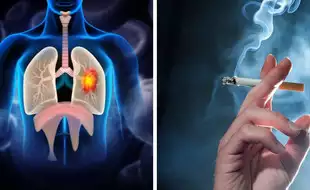 It's Not Just Smoking - Shocking Myths About Lung Cancer Debunked