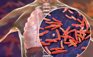 THESE Strains Of Tuberculosis Are Most Infectious, Finds Study