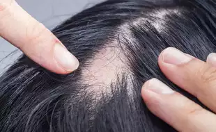 International Alopecia Day 2024: Symptoms and Causes Of The Condition