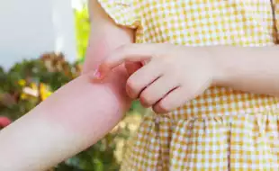 Juvenile Psoriatic Arthritis: Expert Shares Connection Between Red Rash and Joint Inflammation