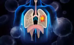 Signs That Lung Cancer Has Spread To Your Brain