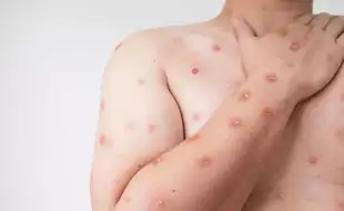 CDC Issues Alert On The Spread Of Severe Mpox Strain In Africa; Signs And Symptoms To Keep A Check On