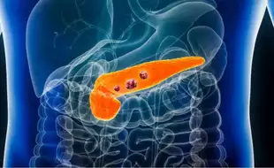 New Antibody Detection Technique Offers Breakthrough in Early Pancreatic Cancer Diagnosis