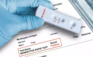 India Develops First Indigenous Mpox RT-PCR Detection Kit, Gets CDSCO Approval