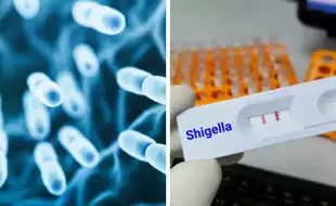 Shigella Outbreak: 3 New Cases Reported Among Homeless In Santa Clara; Know the Signs And Symptoms