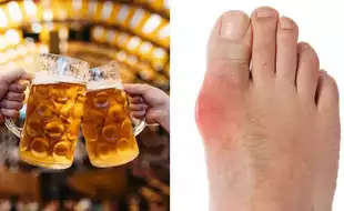 Beware! Drinking Beer, Champagne Can Cause Gout, A Painful Type Of Arthritis