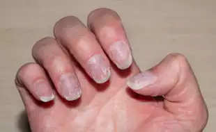 What Your Nails Say About Your Health