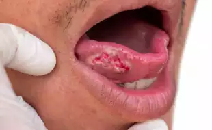 Can You Get Cancer Under Your Tongue?  How Does It Spread?