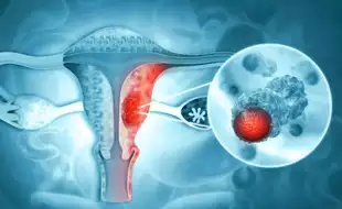 Is Vaginal Discharge A Typical Symptom of Uterine Cancer? Expert Answers