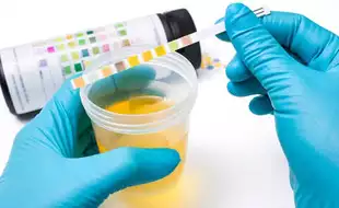 What Does Your Urine Colour Reveal About Your Kidney Health?