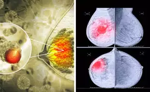 Shorter Course of Radiation Therapy For Breast Cancer Is Safe, Will Not Affect Breast Reconstruction, Says Study