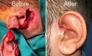 Pet Pitbull Bites Off Man's Ear, Doctors Saves Life Of Patient Through  11-Hour Reconstructive Surgery