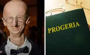 Longest-Living Survivor Of Progeria Dies At 28; What Is This Rare Condition That Causes Rapid Ageing?