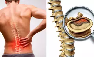 Could My Back Pain Be Spine Cancer? Know Ways To Recognize Spinal Tumours