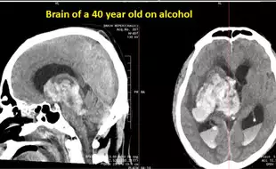 Brain Stroke Warning! The Liver Doc Shares Shocking Brain Scan Of 40-Year-Old Drinker