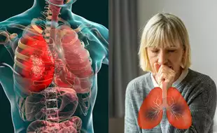 Bronchitis vs. Pneumonia: Expert Tips to Spot the Differences and Seek the Right Care