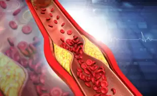 CDC Says Nearly 1 in 10 U.S. Adults Has High Cholesterol, Tips To Reduce Your LDL Levels