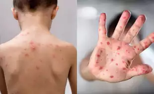 Can You Get Chickenpox As An Adult? Know The Risk Factors And Symptoms Of This Highly-Contagious Virus