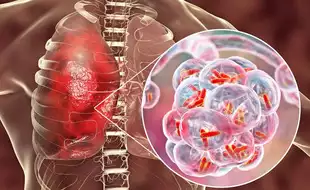 Surge In Mycoplasma Pneumonia Cases In Japan; Here’s What You Need To Know About The Respiratory Tract Infection