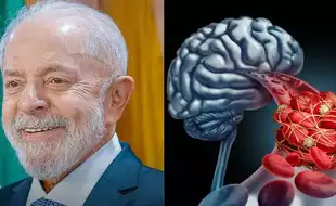 What Is Intracranial Hemorrhage Brazilian President Lula Underwent Surgery For? Know the Severe Complications