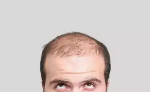 Can You Regrow Hair On A Bald Spot? Yes, Here's How